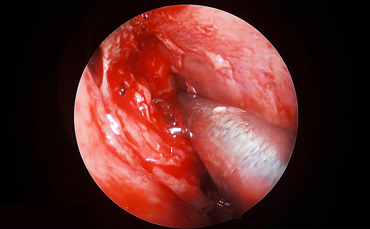 4K超高清內(nèi)窺鏡攝像系統(tǒng)在腦垂體瘤切除術(shù)中的精彩表現(xiàn) 4K超高清內(nèi)窺鏡攝像系統(tǒng)在腦垂體瘤切除術(shù)中的精彩表現(xiàn)