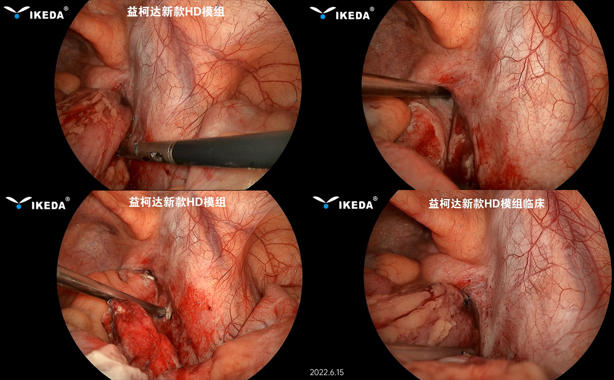 益柯達-新款HD內窺鏡模組首次臨床 益柯達-新款HD內窺鏡模組首次臨床