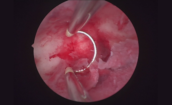 宮腔鏡系統包括哪些設備？如何消毒？